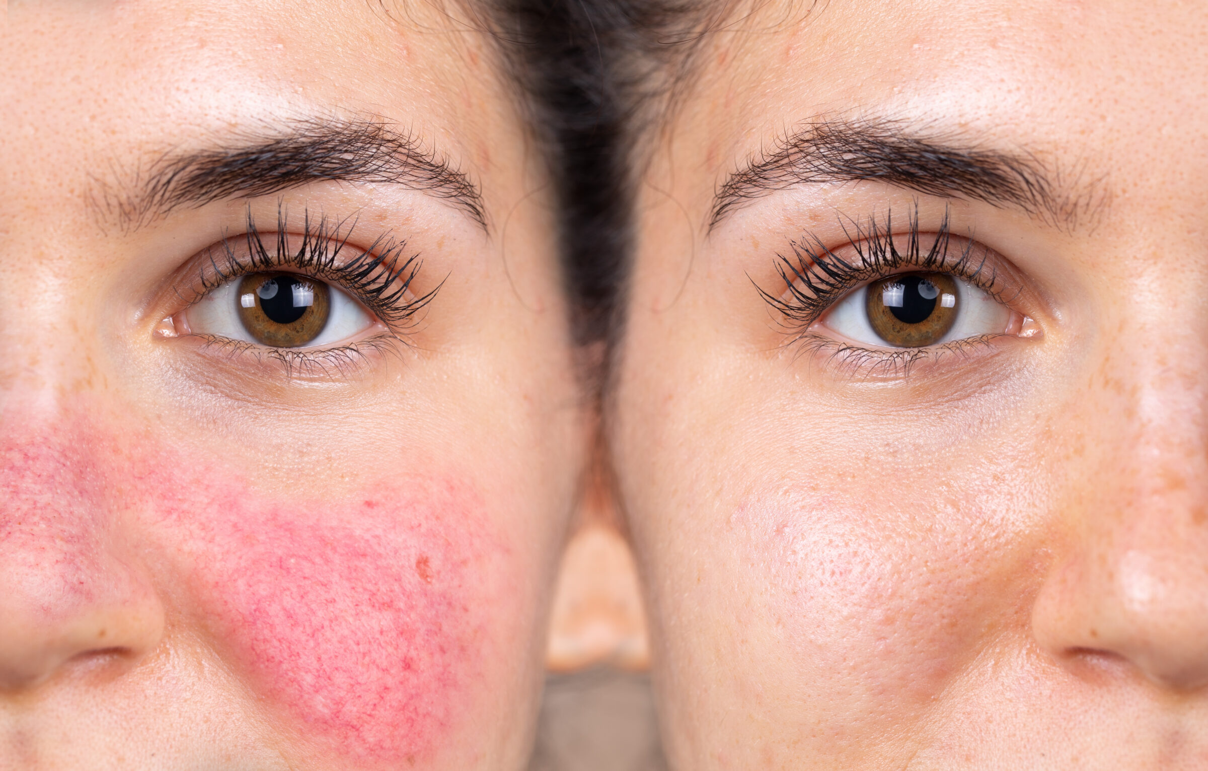 A woman's face before and after Rosacea treatment