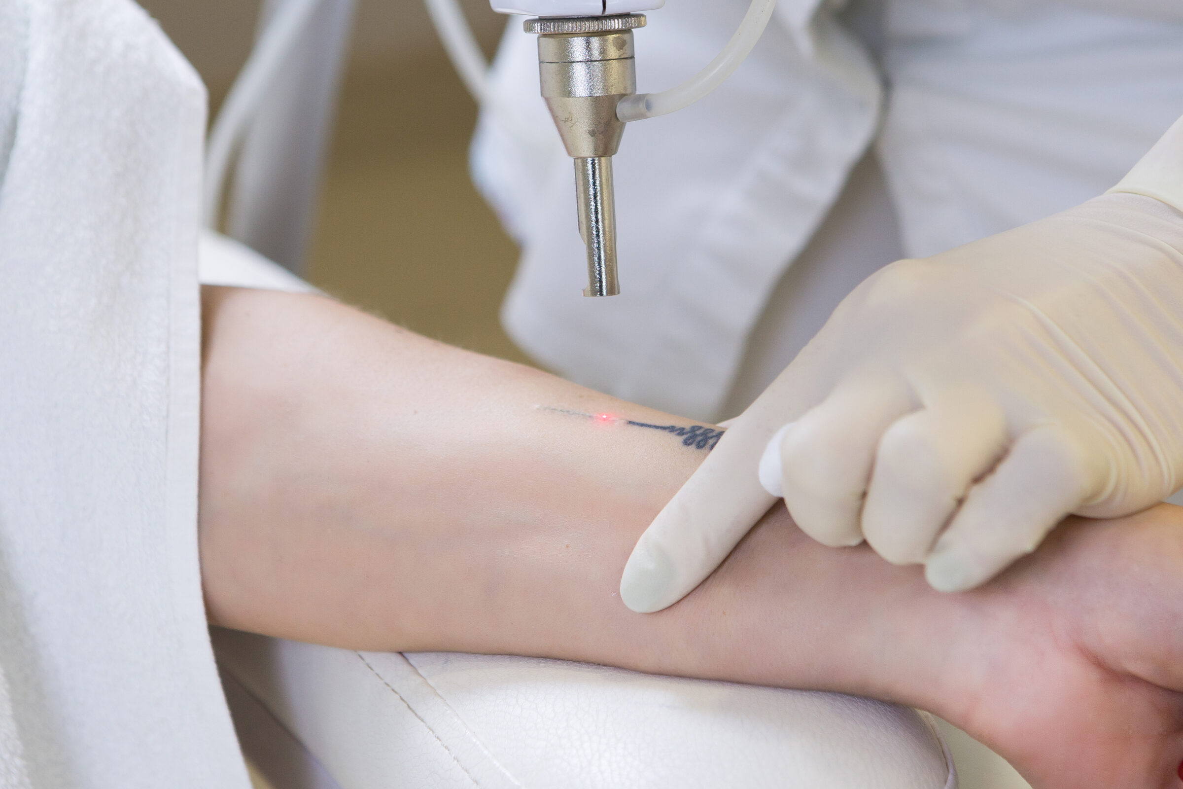 A woman getting laser tattoo removal on her wrist