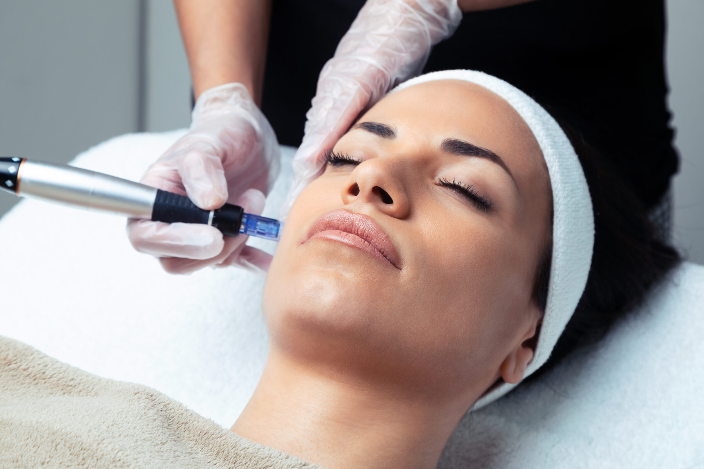 An African American woman getting RF Microneedling treatment on her face